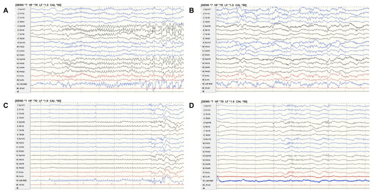 Adult-Onset Febrile Infection-Related Epilepsy Syndrome Treated with Short-Term Anakinra.