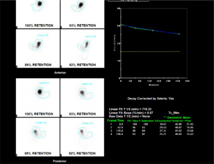 From Fluttering Hearts to Restless Stomach: Navigating Atrial Fibrillation, Ablation and Gastroparesis.