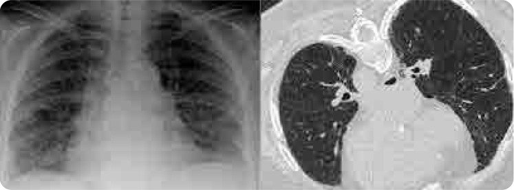 Methotrexate-Associated Hypersensitivity Pneumonitis After 15 Years of Use: A Case Report and Literature Review.