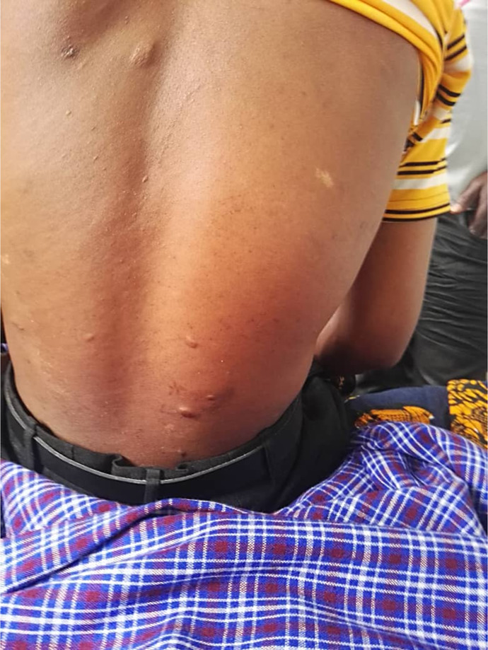 Challenges in the Diagnosis and Care of Tuberous Sclerosis Complex in Resource-Limited Settings: A Case Report from Tanzania.