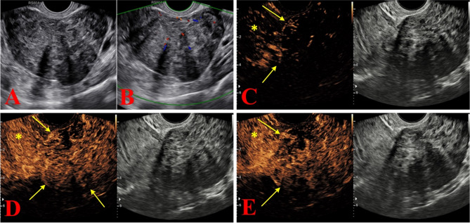 Accurate prediction of benign and malignant adnexal tumors in surgical resection and conservative treatment: construction and external validation of a diagnostic model based on CEUS, HE4, and O-RADS US v2022 evaluation.