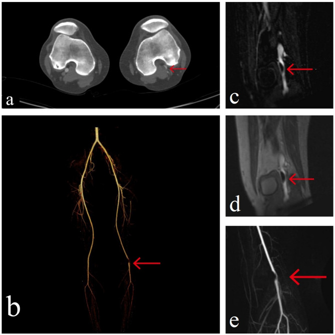 Cystic adventitial disease of the popliteal artery in female: case report and literature review of a rare differential diagnose of artery stenosis.