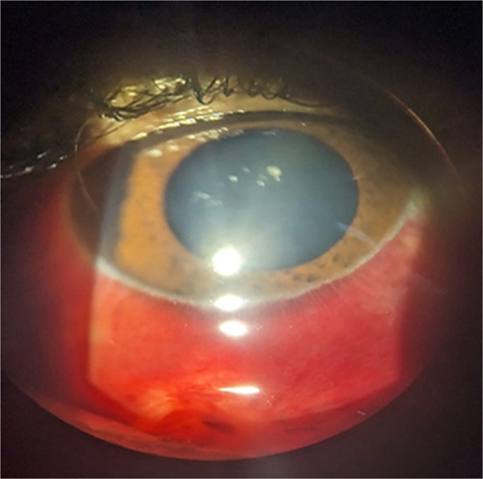 Magnetic Extraction of an Intraretinal Foreign Body: A Case Report.