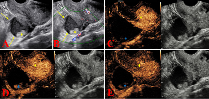 Accurate prediction of benign and malignant adnexal tumors in surgical resection and conservative treatment: construction and external validation of a diagnostic model based on CEUS, HE4, and O-RADS US v2022 evaluation.