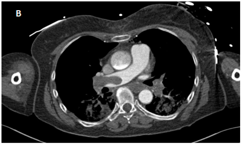 Case Report of Successful Extracorporeal CPR (eCPR) in Refractory Cardiac Arrest Caused by Fulminant Pulmonary Embolism with Remarkable Recovery.