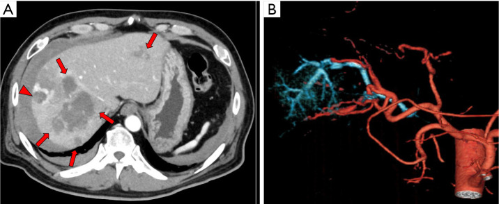 Tract hemostasis using radiofrequency ablation for hepatic arterial bleeding after percutaneous transhepatic portal embolization.
