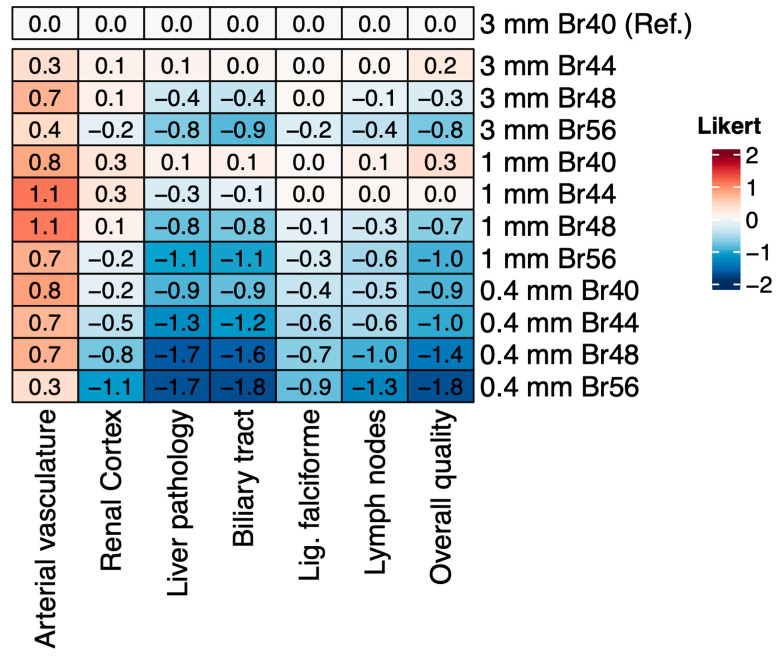 Optimizing Imaging Parameters for Assessment of Hepatocellular Carcinoma Using Photon-Counting Detector Computed Tomography-Impact of Reconstruction Kernel and Slice Thickness.