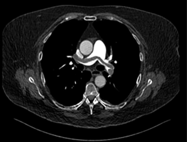 Near-fatal saddle pulmonary embolism following chemoradiotherapy and brachytherapy for locally advanced cervical cancer: A case series.