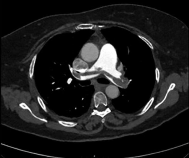 Near-fatal saddle pulmonary embolism following chemoradiotherapy and brachytherapy for locally advanced cervical cancer: A case series.