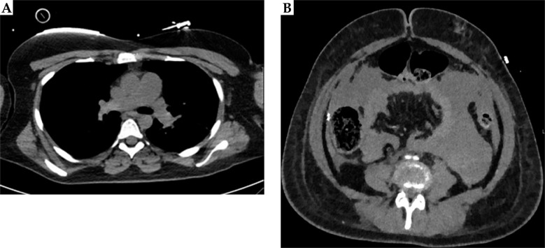 Near-fatal saddle pulmonary embolism following chemoradiotherapy and brachytherapy for locally advanced cervical cancer: A case series.