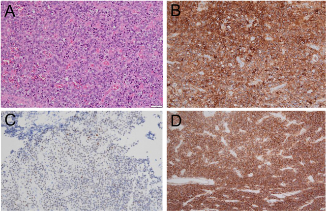 Effects of lanreotide autogel immediately after a single injection for thyrotropin-producing pituitary tumor.