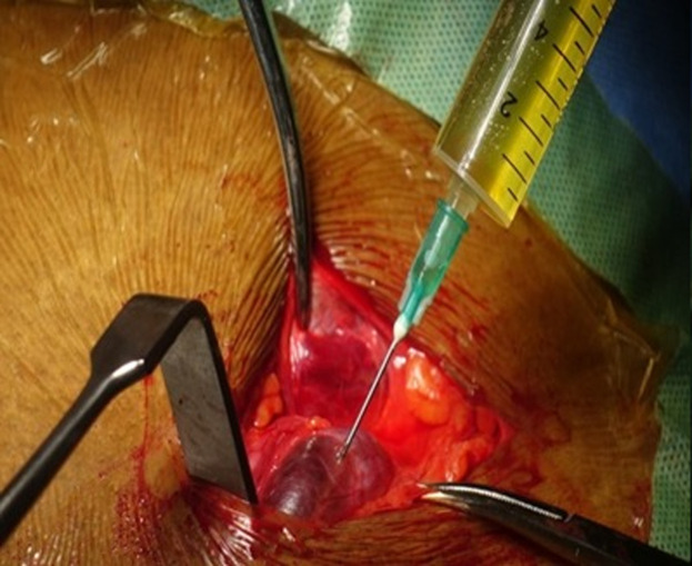 Hydrocele of the canal of Nuck mimicking an inguinal hernia in a 34-year-old pregnant woman: a case report.