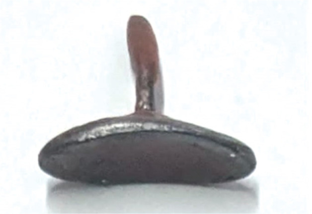 The irreplaceable art of brachytherapy: A technical note on interstitial high-dose-rate interventional radiotherapy (brachytherapy) in eyelid tumors.