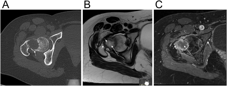 Novel <i>FRMD6::PTH</i> chimera in tumorous bone lesion carrying a t(4;11;14;12)(q35;p15;q22;q13).