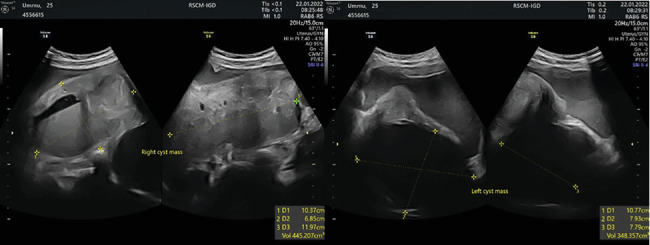 Silent Threat: Bilateral Giant Asymptomatic Endometriotic Cysts With Unilateral Sudden Rupture-A Case Report.