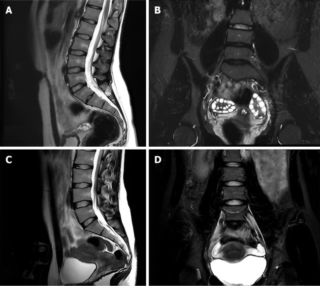 Enhancing back pain and sciatica diagnosis: Coronal short tau inversion recovery's role in routine lumbar magnetic resonance imaging protocols.