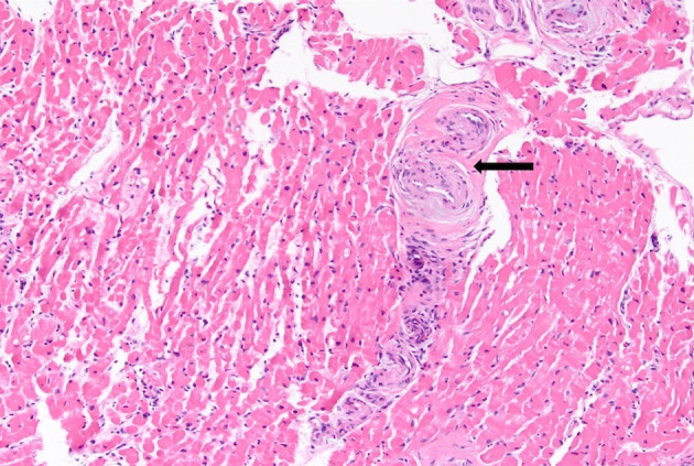 Light Chain (AL) Amyloidosis Masquerading as Scleroderma: A Diagnostic Challenge.