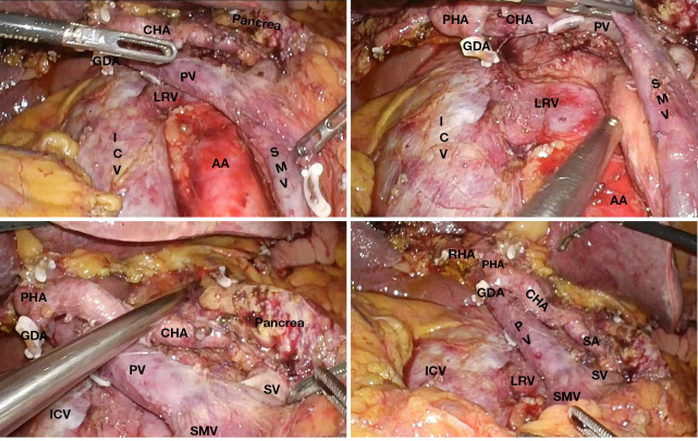 Risk factors for postoperative outcomes in laparoscopic pancreaticoduodenectomy: a retrospective cohort study from 2015 to 2023.