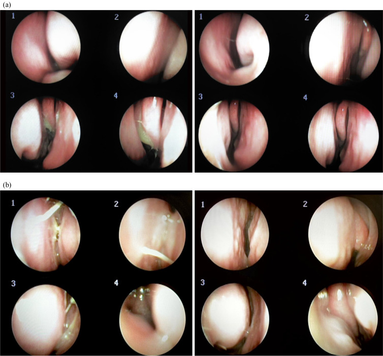 Management of Perennial Allergic Rhinitis Complicated by Rhinosinusitis Using Ultrasound-Guided Sphenopalatine Ganglion Acupuncture and Modified Socheongryong-tang: two CARE-compliant case reports.