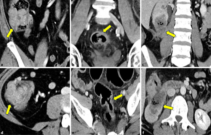 [Role of radiology for primary staging of colorectal cancer].