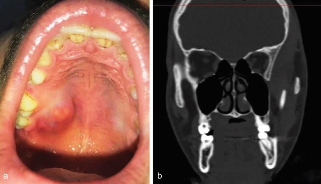 Immunohistochemical Analysis of Oral Spindle Cell Hemangioma.