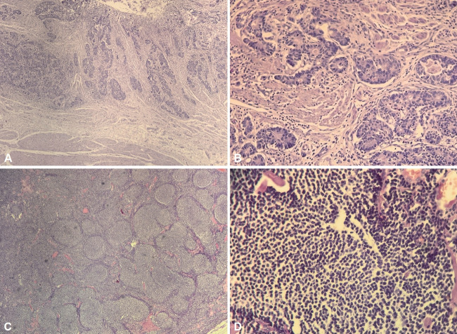 Gastric Adenocarcinoma and Synchronic Mantle Cell Lymphoma: A Case Report.