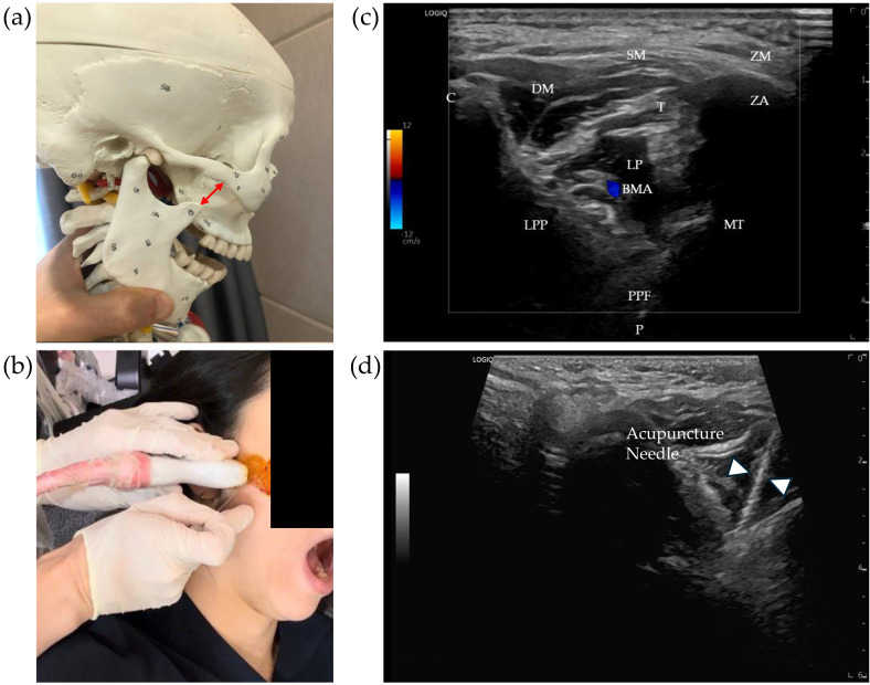 Management of Perennial Allergic Rhinitis Complicated by Rhinosinusitis Using Ultrasound-Guided Sphenopalatine Ganglion Acupuncture and Modified Socheongryong-tang: two CARE-compliant case reports.