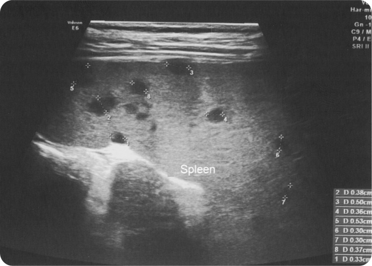 Kawasaki Disease or Cat Scratch Disease? A Diagnostic Dilemma: A Paediatric Case Report and Literature Review.