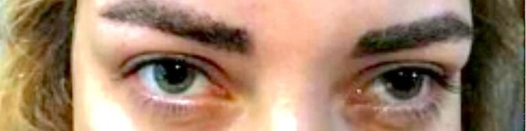 Bilateral Mydriasis in a Post-parotidectomy Patient: A Case Report.
