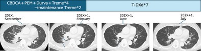 Successful Treatment of HER2 V659E Mutation-Positive Lung Adenocarcinoma With Trastuzumab Deruxtecan: A Case Report.