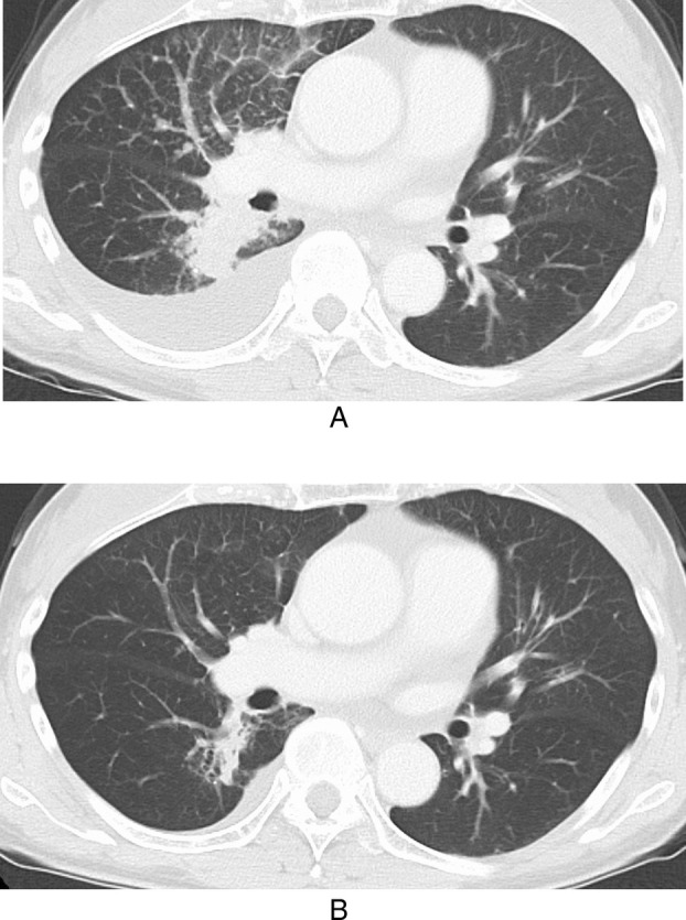 Successful Treatment of HER2 V659E Mutation-Positive Lung Adenocarcinoma With Trastuzumab Deruxtecan: A Case Report.