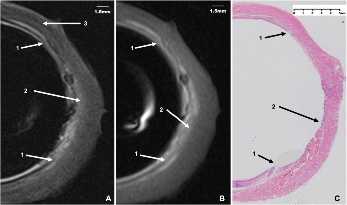 Ex vivo study of Porcine esophagus magnetic resonance imaging with a compact endoluminal coil.