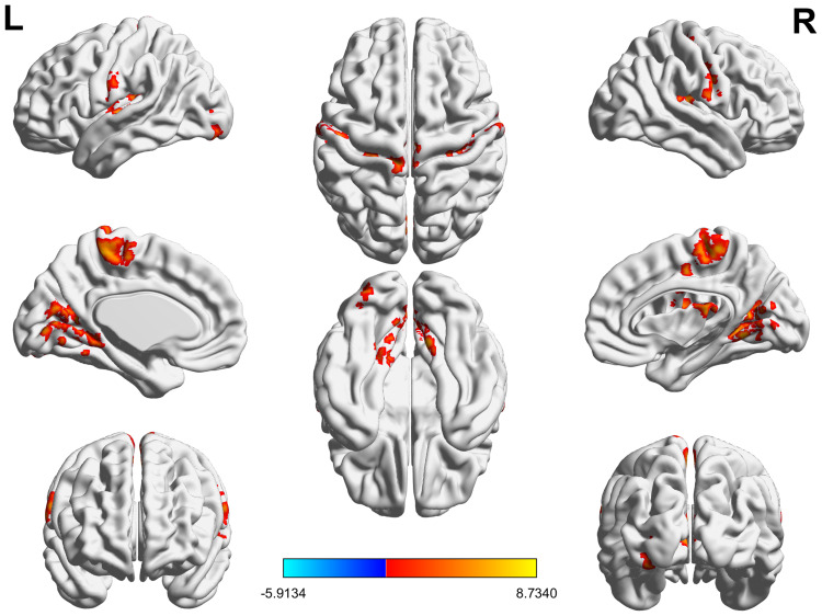 Functional Brain Activity Alterations in Type 1 Narcolepsy Patients with Anxiety and Depression: A 7-Tesla Resting State-Functional Magnetic Resonance Imaging Study.