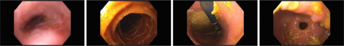 From Fluttering Hearts to Restless Stomach: Navigating Atrial Fibrillation, Ablation and Gastroparesis.