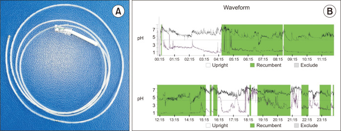 Twenty-four-hour pH monitoring of gastric conduit in post-esophagectomy patients: correlation with clinical and endoscopic parameters in a prospective cohort study from India.