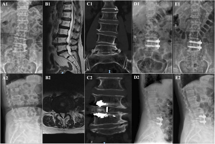 Clinical evaluation and finite element analysis of bone cement-augmented anterolateral screw fixation versus percutaneous bilateral pedicle screw fixation co-applied with oblique lumbar interbody fusion for single-level lumbar degenerative diseases with osteoporosis.