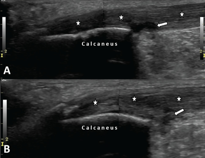 Aromatase Inhibitor-Related Lower Limb Tendinopathies: Ultrasound is on the Agenda.
