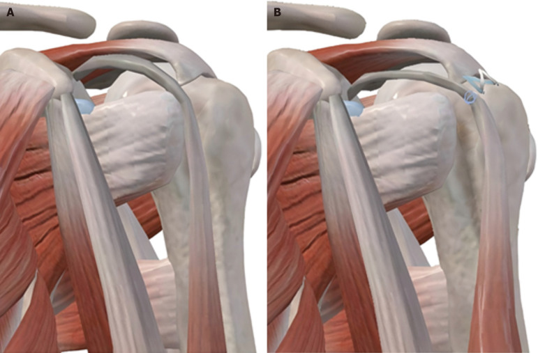 Clinical comparison of arthroscopic double-row rotator cuff repair with or without long head of biceps tendon transposition.