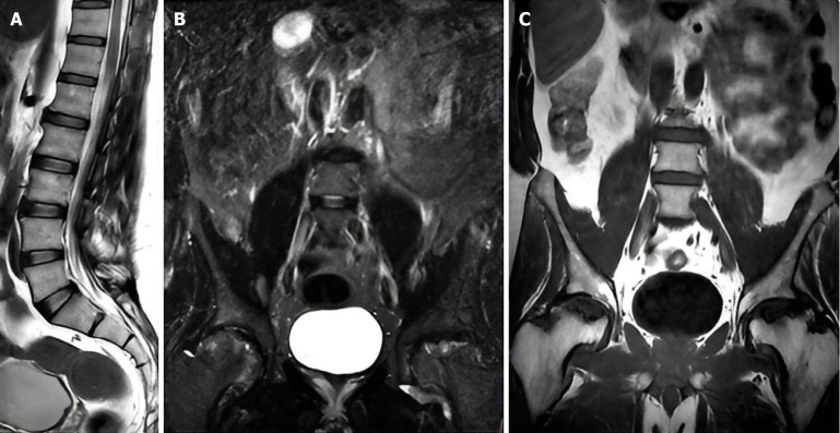 Enhancing back pain and sciatica diagnosis: Coronal short tau inversion recovery's role in routine lumbar magnetic resonance imaging protocols.