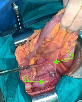An Extremely Rare Anomaly: Unveiling Renal Vein-Originated Leiomyosarcoma.