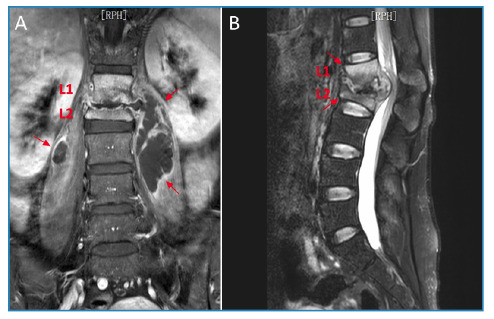 Shining star-like appearance in Pott's disease.