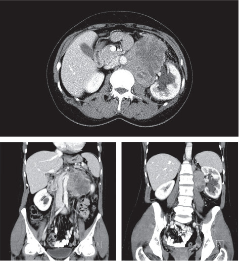 An Extremely Rare Anomaly: Unveiling Renal Vein-Originated Leiomyosarcoma.