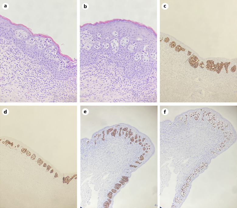 Spontaneously Regressing Penile Extramammary Paget Disease without Recurrence of Primary Urothelial Carcinoma: A Case Report.