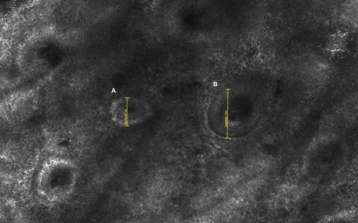 Pigmented Rings With Central Clearing: A Dermoscopic Feature of Melasma.
