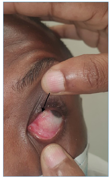 Ocular Filariasis caused by Loa loa infection.