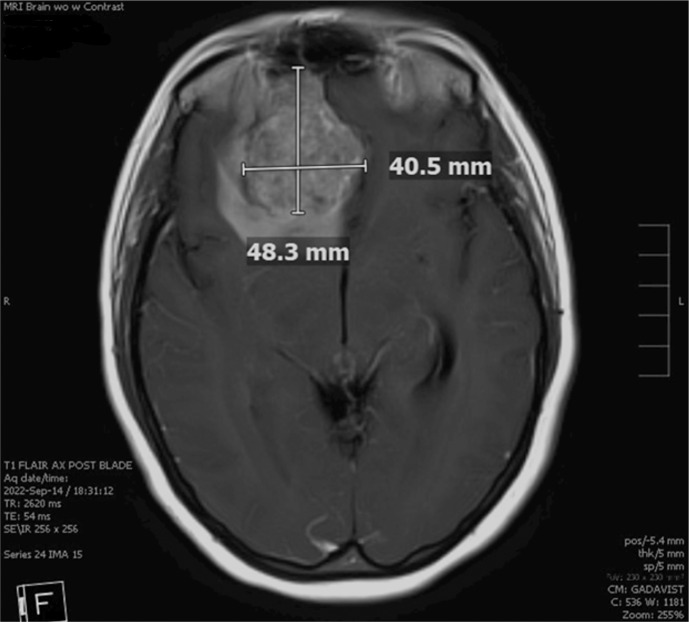 Aggressive Craniospinal Recurrence of a <i>PTEN</i>-Mutated Sinonasal Teratocarcinosarcoma: A Case Report.