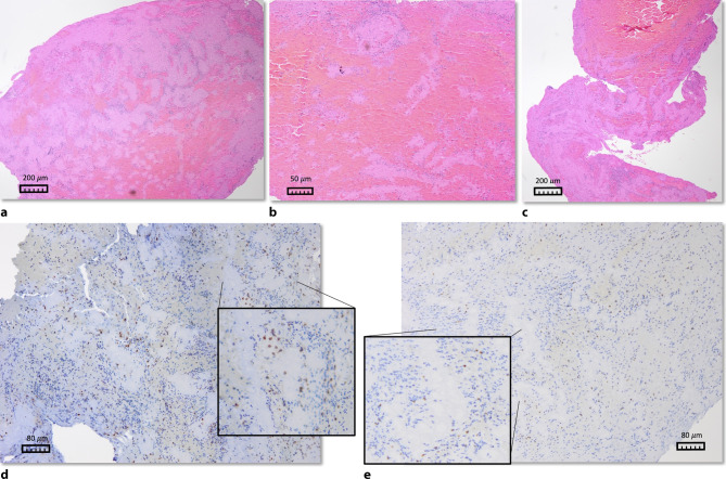 Thrombo-CARE-cardioembolic stroke etiology in cryptogenic stroke suggested by fibrin-/platelet-rich clot histology : Thrombo-CARE (configuration analysis to refine etiology).