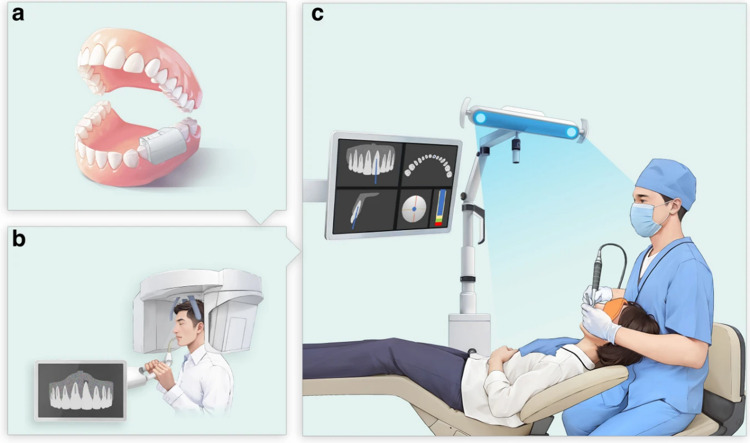 Guided endodontics in the application of personalized mini-invasive treatment in clinical cases: a literature review.