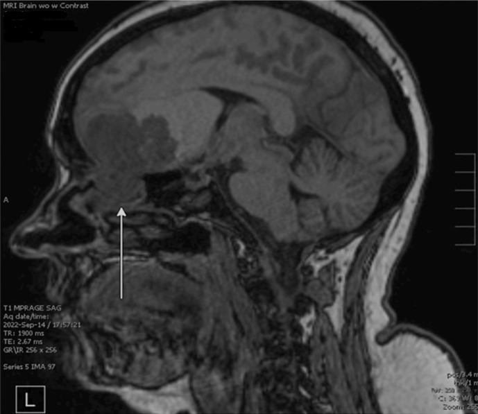 Aggressive Craniospinal Recurrence of a <i>PTEN</i>-Mutated Sinonasal Teratocarcinosarcoma: A Case Report.