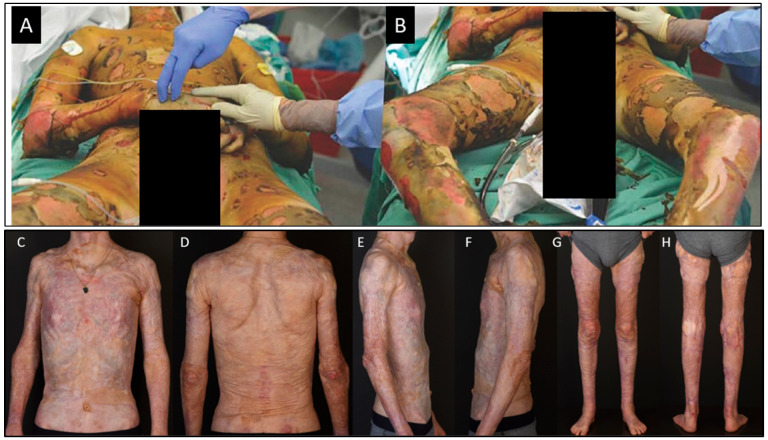 Laboratory-Generated Autologous Skin Substitutes for Burn Treatment in Europe: Narrative Review, Experts' Opinion, and Legal Considerations.